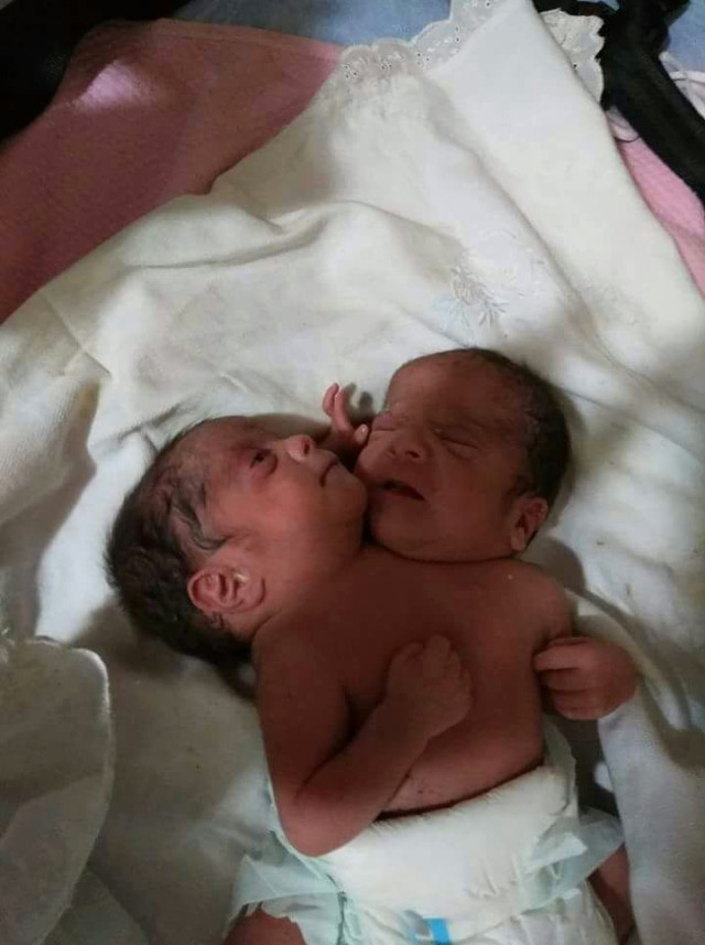 Suriye'nin İdlib kentinde yaşayan 28 yaşındaki bir kadın siyam ikizi doğurdu.<br>30. HAFTADA DOĞDULAR<br>Üçüncü çocuğuna hamile olan Rağde El-Delli'nin (28) sancıları başlayınca eşi tarafından hastaneye kaldırıldı. Ancak çiftin sezaryenle çift başlı bebekleri dünyaya geldi. Tek vücutta doğan yapışık ikizler, karın ve göğüs bölgelerinden yapışık halde, aynı karaciğeri